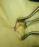 Karpaltunnel-Syndrom Karpaltunnel-Syndrom