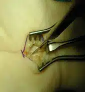 Karpaltunnel-Syndrom Karpaltunnel-Syndrom