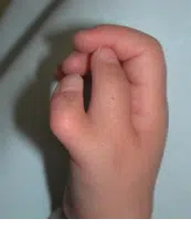 Kindliche Fehlbildungen Kindliche Fehlbildungen