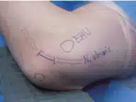 Kubitaltunnel Kubitaltunnel