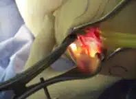 Kubitaltunnel Kubitaltunnel