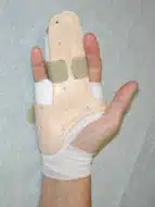 Morbus Dupuytren Morbus Dupuytren