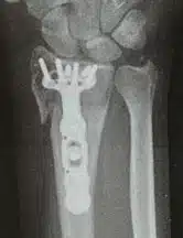 Radiusfraktur Radiusfraktur