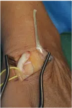 Sehnenerkrankungen Sehnenerkrankungen