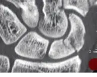 Skaphoidfraktur Skaphoidfraktur