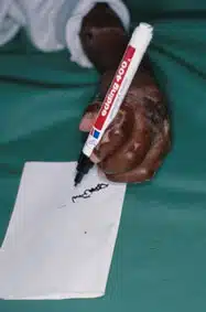 Weichteildefekte Weichteildefekte